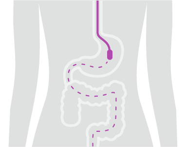 GI procedure illustration